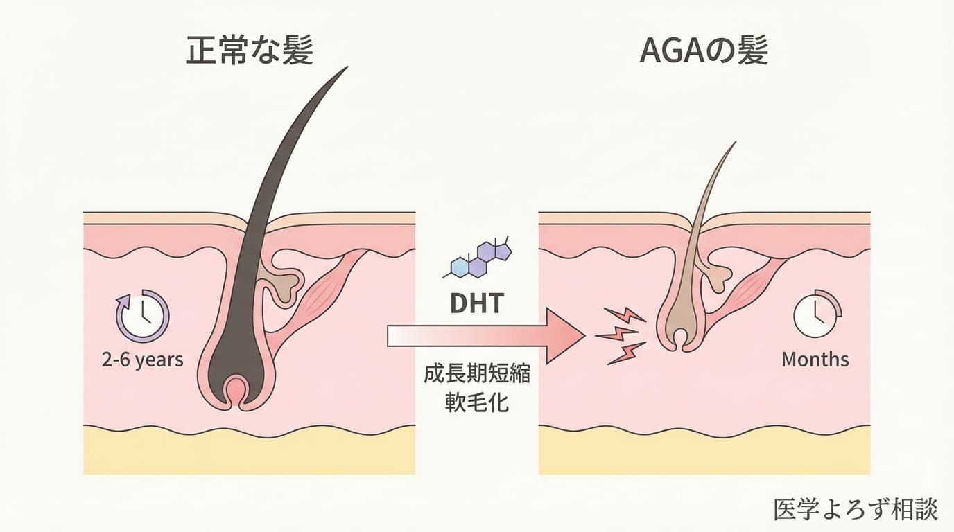 AGAのメカニズム：DHTによるヘアサイクルの短縮