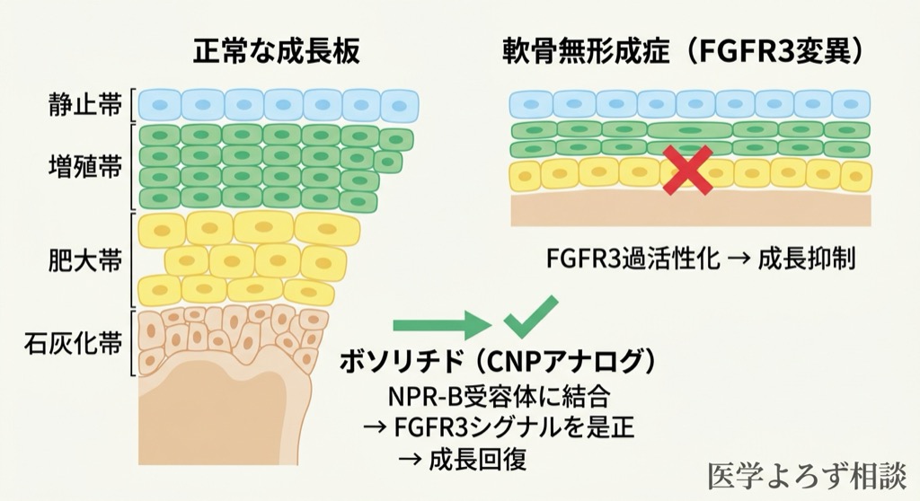成長板の仕組みとボソリチドの作用機序を示す図解。FGFR3の過活性化による成長抑制と、CNPアナログ（ボソリチド）による是正を対比して図示