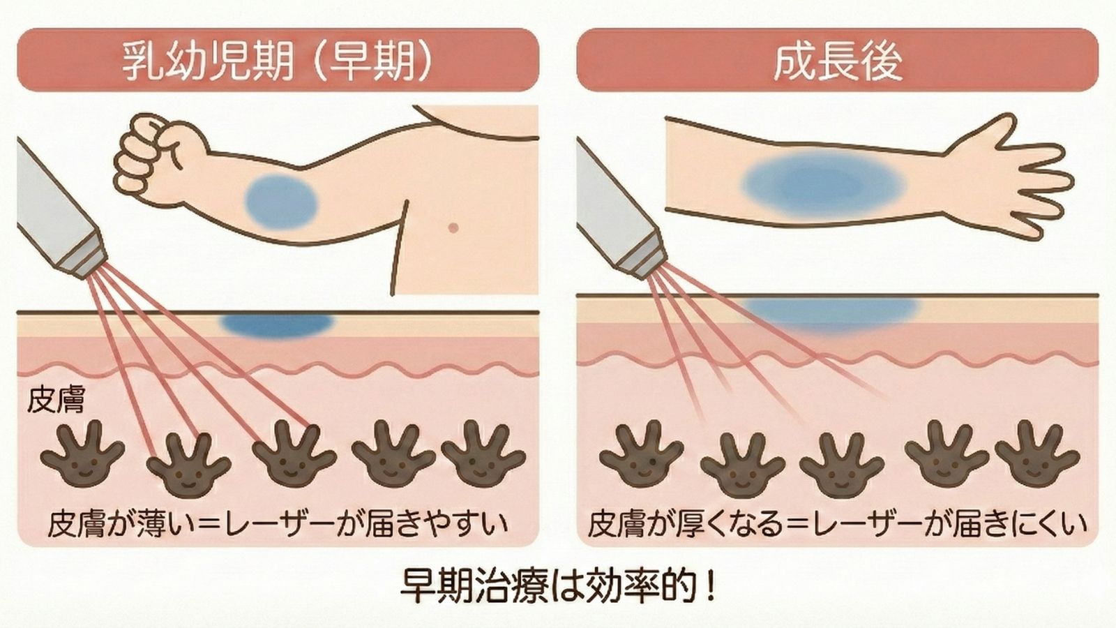 乳幼児期早期治療と成長後の比較