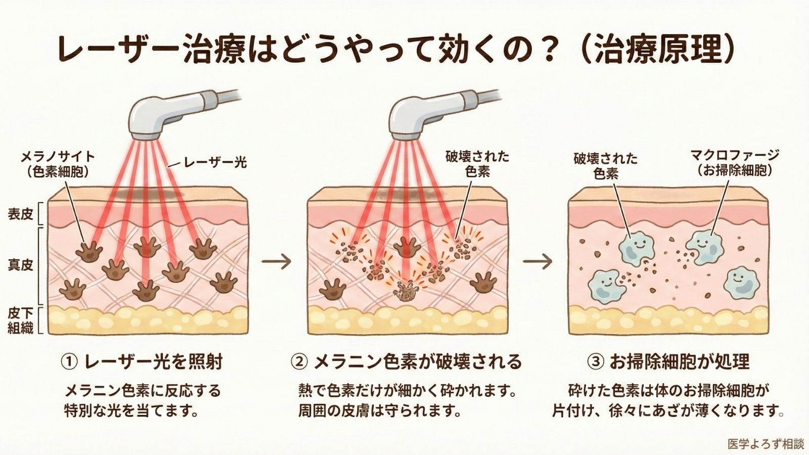 Qスイッチレーザーによる治療原理