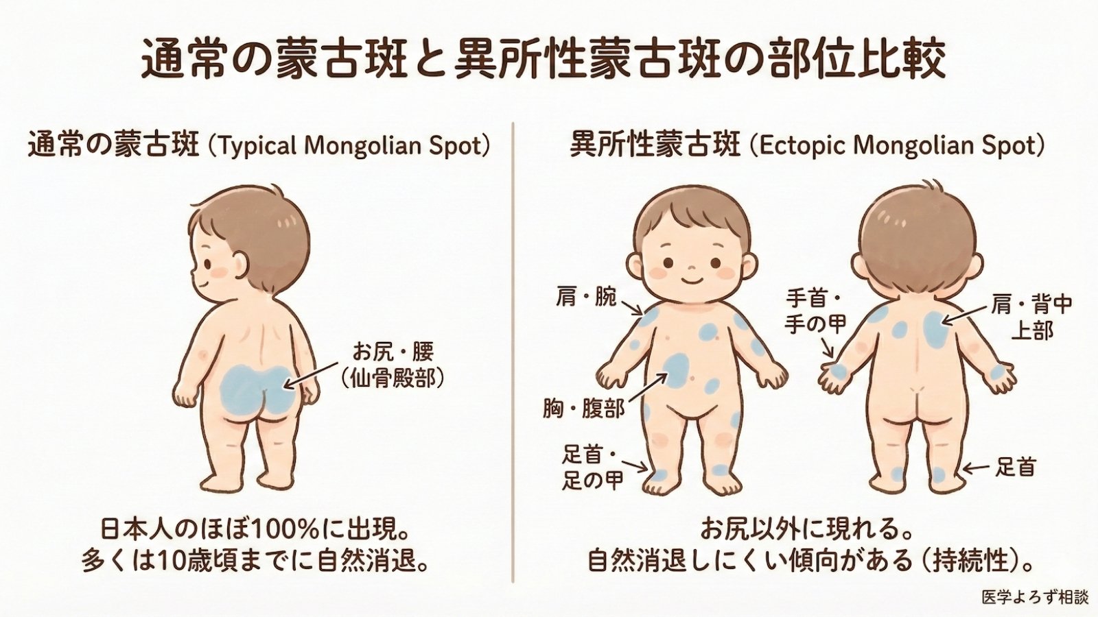 通常の蒙古斑と異所性蒙古斑の部位比較図