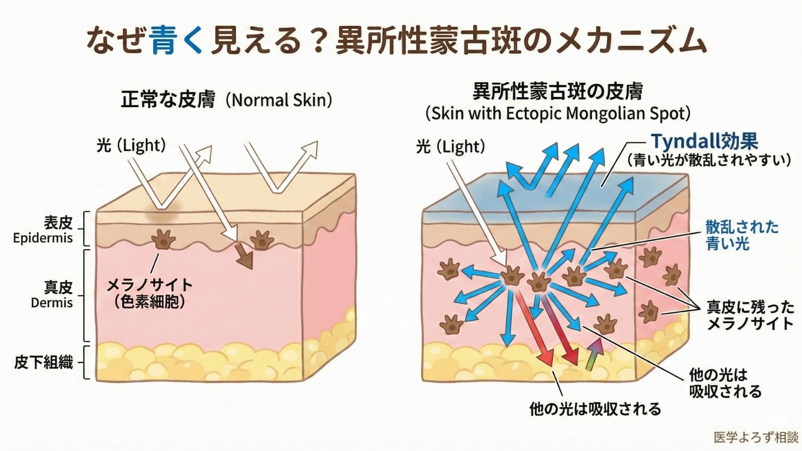 Tyndall効果による異所性蒙古斑のメカニズム