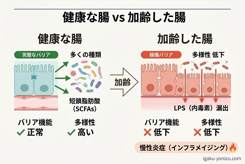 インフラメイジングのメカニズムを示す模式図。腸管バリア破綻、LPS漏出、全身性慢性炎症の連鎖を描く