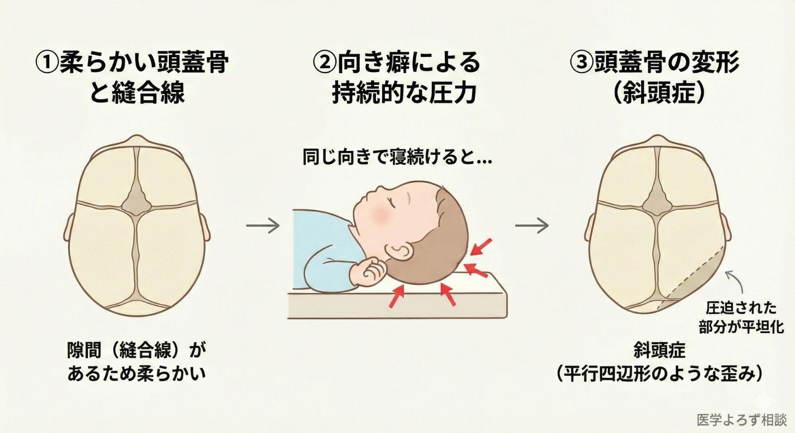 位置的斜頭症の発生メカニズム