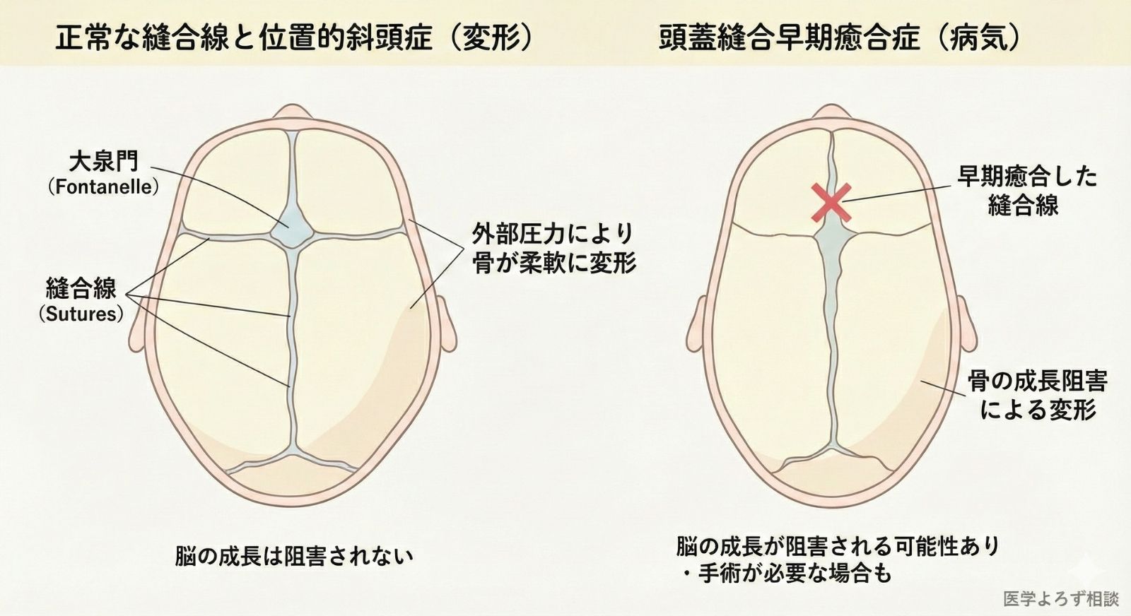 位置的斜頭症と頭蓋縫合早期癒合症の鑑別比較図